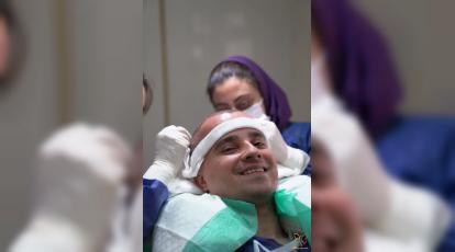 چند روز بعد از کاشت مو ریزش شروع میشود؟ همه چیز درباره شوک ریزش پس از کاشت