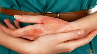 اسکلرودرمی و زیبایی: کدام خدمات (بوتاکس، ژل، لیزر) ممنوع و کدام مجاز است؟