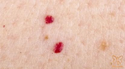 آیا خال گیلاسی خطرناک است؟ همه چیز درباره خال گیلاسی و درمان قطعی آن در مشهد