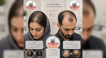  مقایسه تاثیر نیدلینگ سر برای تقویت رشد مو در خانم‌ها و آقایان
