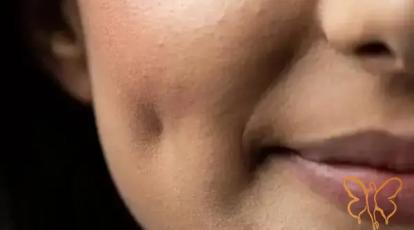 پشیمانی بعد از عمل چال گونه: از ظاهر مصنوعی تا عوارض دائمی + راه حل