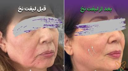 راز داشتن چهره‌ای جوان‌تر در یک ساعت: همه چیز درباره لیفت با نخ