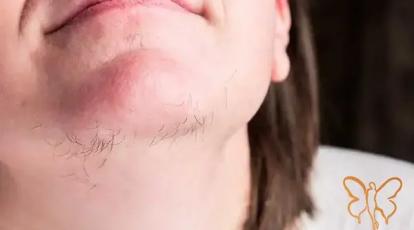 موهای زائد زیر چانه: از علت تا درمان قطعی با لیزر کندلا در مشهد | کلینیک شاپرک طلایی