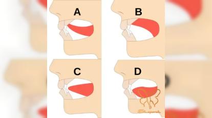 تغییر استخوان فک فقط با زبان؟! چالش ۳۰ روزه “میوینگ” برای خداحافظی با غبغب