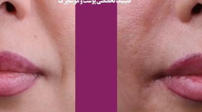 ژل ژوویدرم فرانسوی: زیبایی طبیعی با استاندارد طلایی اروپا در شاپرک طلایی مشهد