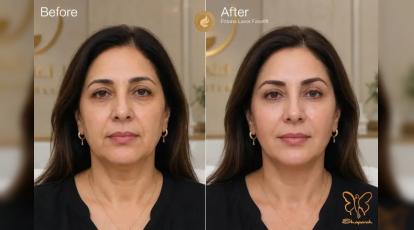 لیزر فوتونا برای لیفت و جوانسازی صورت چقدر ماندگاری دارد؟ | بررسی جامع در شاپرک مشهد