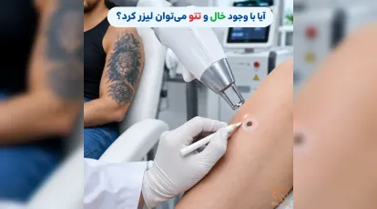 آیا لیزر روی تتو و خال ممنوع است؟ | رازهای طلایی در بهترین کلینیک لیزر مشهد!