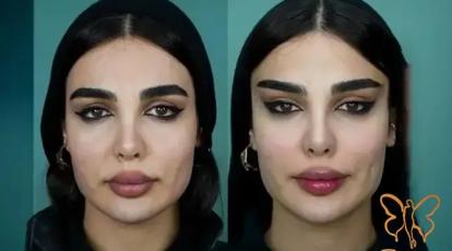 عوارض جراحی لیفت شقیقه: فقط شایعه است یا واقعیت دارد؟ | کلینیک شاپرک طلایی پاسخ می‌دهد