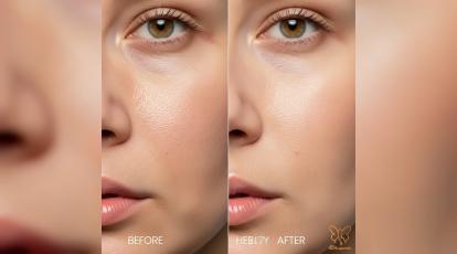 کاربرد مزوبوتاکس استیلاد در کاهش منافذ باز پوست در مشهد