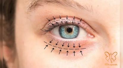 انواع بخیه در بلفاروپلاستی در مشهد: راز نتیجه طبیعی و بدون اسکار در شاپرک طلایی