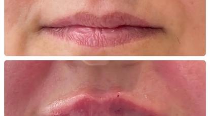تزریق ژل لب حرفه‌ای در مشهد چرا کلینیک شاپرک طلایی انتخاب اول شماست؟