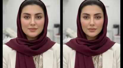 هایفوتراپی چربی سوز بوکال فت در مشهد | صورت خود را بدون جراحی زاویه سازی کنید!