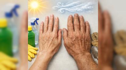 بررسی علل پیری دست خانم ها و آقایان + درمان آن در کلینیک شاپرک مشهد
