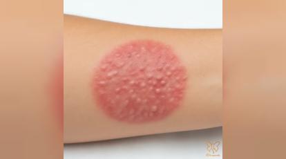 از تاول تا ترمیم؛ انواع سوختگی و بهترین روش‌های از بین بردن اسکار آن در کلینیک شاپرک طلایی مشهد