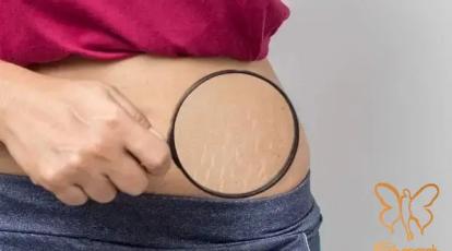 درمان ترک‌های پوستی: چرا استریا گاهی “درمان‌ناپذیر” به نظر می‌رسد؟ 