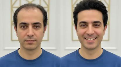راز بازگشت به جوانی: تجربه‌ای متفاوت از کاشت مو در شاپرک طلایی