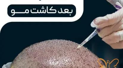 تقویت معجزه‌آسای موهای کاشته شده با مزوتراپی | از ریزش بعد از کاشت جلوگیری کنید