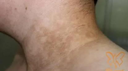 لک قهوه‌ای روی بدن: قارچ یا حساسیت؟ درمان قطعی در کلینیک شاپرک طلایی مشهد