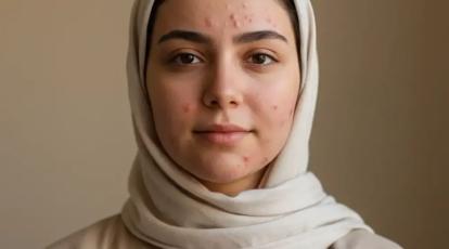 آکنه هورمونی یا قارچی؟ تفاوت را بشناسید و برای همیشه درمان شوید! | کلینیک شاپرک طلایی