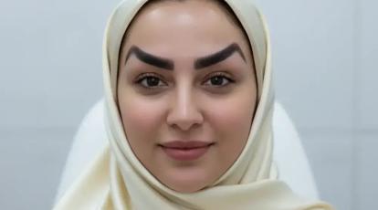 ابروی شیطانی بعد از تزریق بوتاکس: علت، درمان و راه جلوگیری در کلینیک شاپرک طلایی