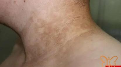 قارچ پوستی بعد از استخر: راهنمای کامل پیشگیری و درمان قطعی در مشهد