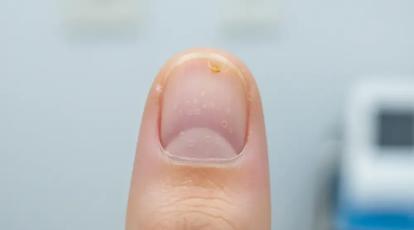 پسوریازیس ناخن: از تشخیص تا درمان قطعی در کلینیک شاپرک طلایی مشهد