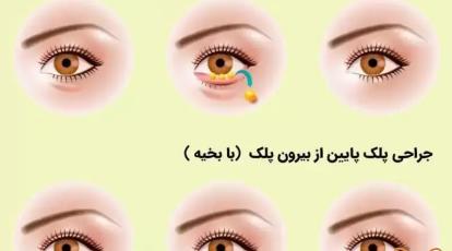 بلفاروپلاستی ترانس کونژانکتیوال در مشهد: رفع دائمی پف زیر چشم بدون بخیه در کلینیک شاپرک