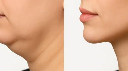 رفع غبغب در مشهد: 3 روش قطعی و بدون جراحی در کلینیک شاپرک طلایی