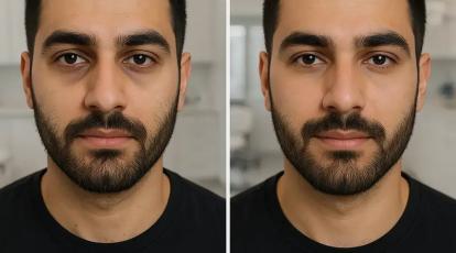 پاسخ به تمام سوالات کلیدی درباره فیلر زیر چشم: هر آنچه قبل از تزریق باید بدانید