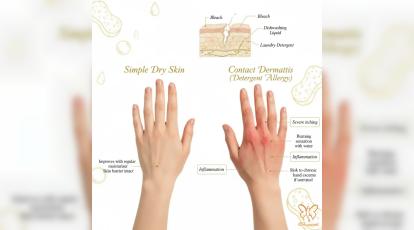 درمان قطعی حساسیت پوست دست به وایتکس و شوینده‌ها | راهکارهای فوری دکترهای شاپرک