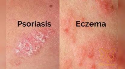  لیزر موهای زائد برای افراد دارای پسوریازیس و اگزما در مشهد