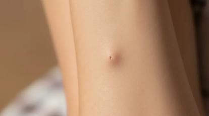 درمان قطعی کیست مویی در مشهد: پایان درد با جراحی نوین در کلینیک شاپرک طلایی