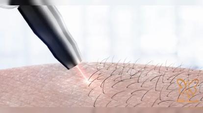 تاریخچه دستگاه لیزر موهای زائد: لیزر با موهای بدن شما دقیقا چه میکند؟