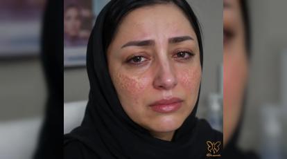 عوارض کرم پودر دائم (BB Glow) که شما را پشیمان می‌کند | راهکار علمی در مشهد 