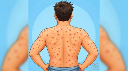 جوش کمر و پشت ناشی از چیست؟ +درمان قطعی و رفع جای لک در مشهد