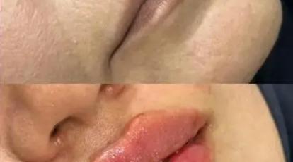 قبل و بعد از فیلر لب چه کار هایی را نباید انجام داد؟ نکات کلیدی در کلینیک تخصصی پوست و مو شاپرک طلایی