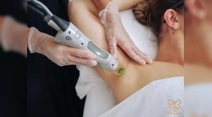 جنگ نوره و لیزر در مشهد: کدام یک برای حذف دائمی موهای زائد بهتر است؟