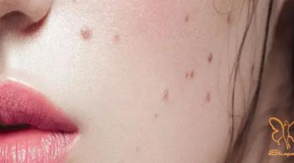 راز داشتن پوستی یکدست: صفر تا صد شناخت و درمان قطعی خال و زگیل