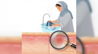 از راش‌های پوستی تا ریزش مو؛ همه چیز درباره عوارض و درمان بیماری تیفوس