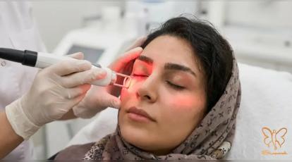 چشم گربه‌ای با جراحی کانتوپلاستی یا جوانسازی دورچشم با لیزر فوتونا؟ انتخاب نهایی در مشهد