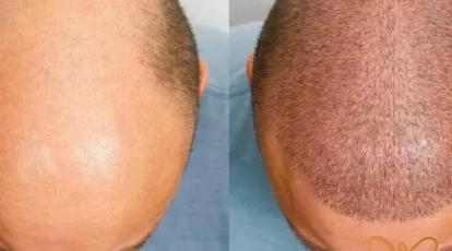 کاشت مو در مشهد: FIT/FUT یا نیدل؟ معجزه ی بازگشت موهای از دست رفته