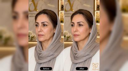 فیلر یا مزوبایواستتیکس؟ رازی که پزشکان برای جوانی طبیعی پوست به شما نمی‌گویند!