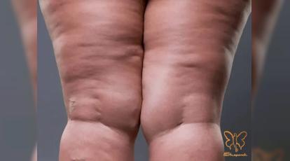 اسکراب قهوه یا لیزر فوتونا؟ کدام راه برای رفع سلولیت ران در مشهد موثرتر است؟