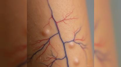 فوتونا فرکشنال آکنه یا عروقی؟ تفاوت‌ها و انتخاب هوشمندانه در کلینیک شاپرک طلایی مشهد