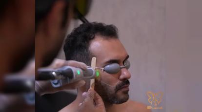 تفاوت لیزر مو زائد در آقایان و خانم ها در مشهد