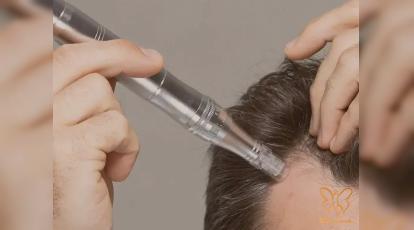 مزونیدلینگ مو در مشهد: معجزه فیوژن و رویتاکر برای درمان ریزش مو