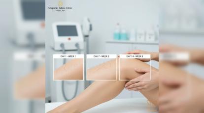 ریزش مو بعد از لیزر چقدر طول می‌کشد؟ | راهنمای کامل کلینیک شاپرک طلایی