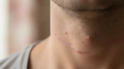 هزینه و مزایای برداشتن گوشت اضافه با لیزر CO2 در بهترین کلینیک مشهد