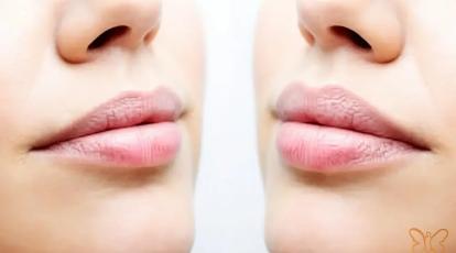 عوارض بوتاکس لیفت لب: آنچه در مشهد باید بدانید | کلینیک شاپرک طلایی