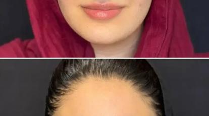 لیفت ابرو بدون جراحی در کمتر از 10 دقیقه در مشهد